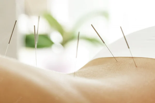 female-back-with-steel-needles-during-procedure-acupuncture-therapy_144962-8550